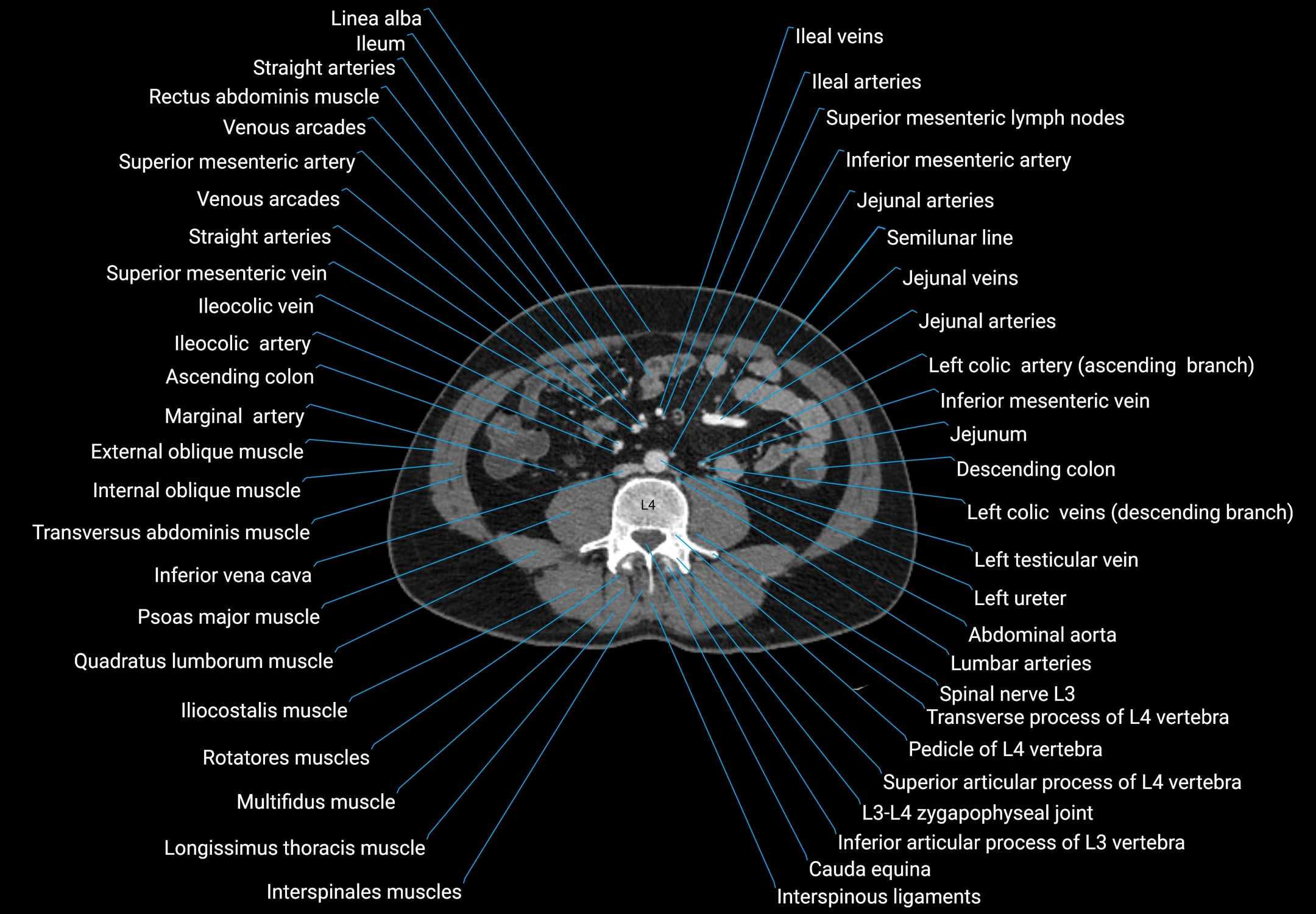 CT male pelvis axial cross sectional anatomy labelled radiology image -00105.webp